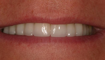 Case 1: After image of cosmetic dentistry in Totowa NJ at Distinctive Dentistry - Contact us to see what our cosmetic dentists can do for you!