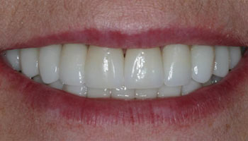 Case 12: After image of cosmetic dentistry in Totowa NJ at Distinctive Dentistry - Contact us to see what our cosmetic dentists can do for you!