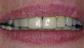 Case 11: Before image of cosmetic dentistry in Totowa NJ at Distinctive Dentistry