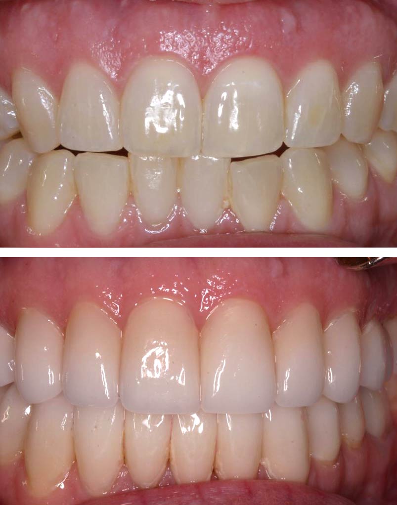An actual before and after full mouth rehabilitation case by Distinctive Dentistry in Totowa NJ
