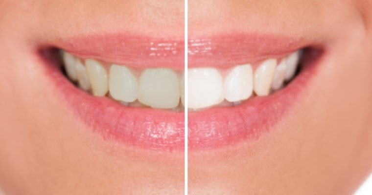 Womans smile before teeth whitening on the left and after on the right